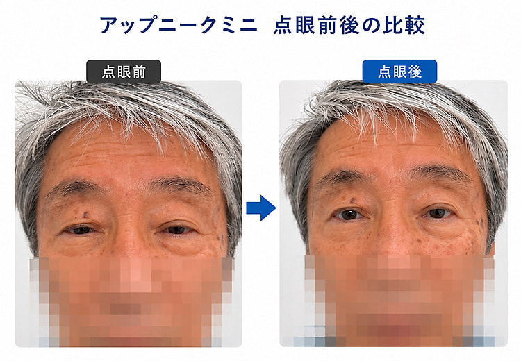 眼瞼下垂イメージ画像